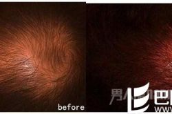 脱发烦恼用毛发移植来解决！！