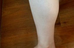 肌肉型小腿的常见人群有哪些 瘦肌肉型小腿的科学方法推荐