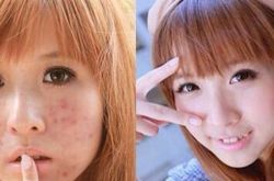 香蕉面膜无法治疗过敏 香蕉面膜的制作方法