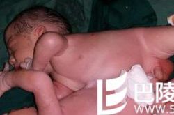 18岁孕妇诞连体双胞胎男婴 肝脏相连体重4.1kg
