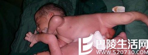 18岁孕妇诞连体双胞胎男婴 肝脏相连体重4.1kg