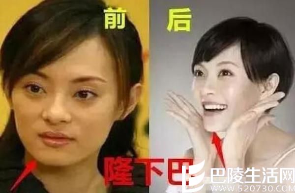 孙俪曾自爆整容 孙俪整容前后照片对比图