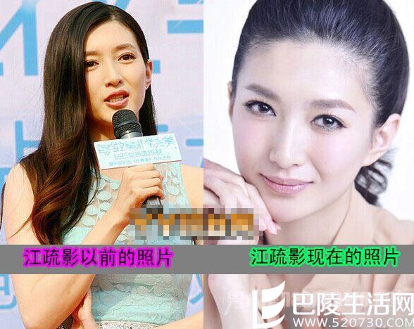 江疏影整容了吗