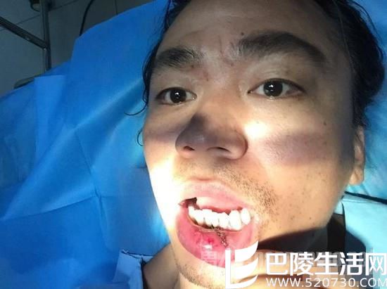 王宝强嘴缝10针