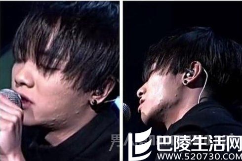 华晨宇痘痘非常吓人 华晨宇痘痘非常吓人