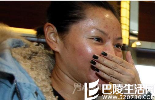 瞿颖“烂脸” 瞿颖“烂脸”