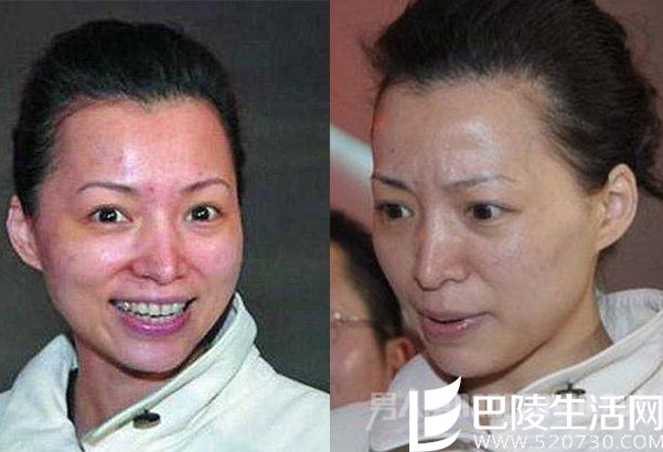 董卿满脸痘印 董卿满脸痘印