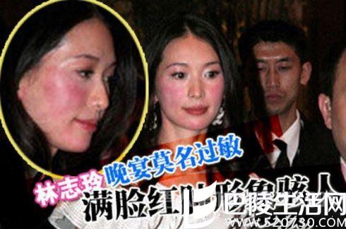林志玲酒精过敏 林志玲酒精过敏