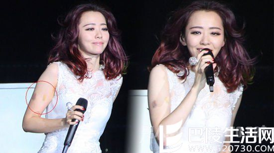 张靓颖淤青是怎么回事 张靓颖淤青是怎么回事