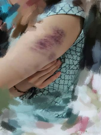 张九南前妻曝报警纪录和验伤单。