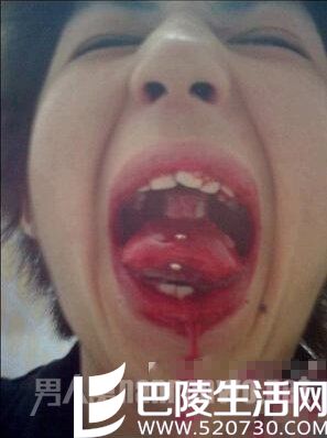 沉珂自残割舌照片令人惊悚