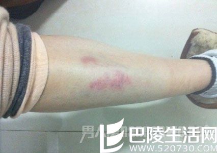 网传孙菲菲腿部瘀伤照