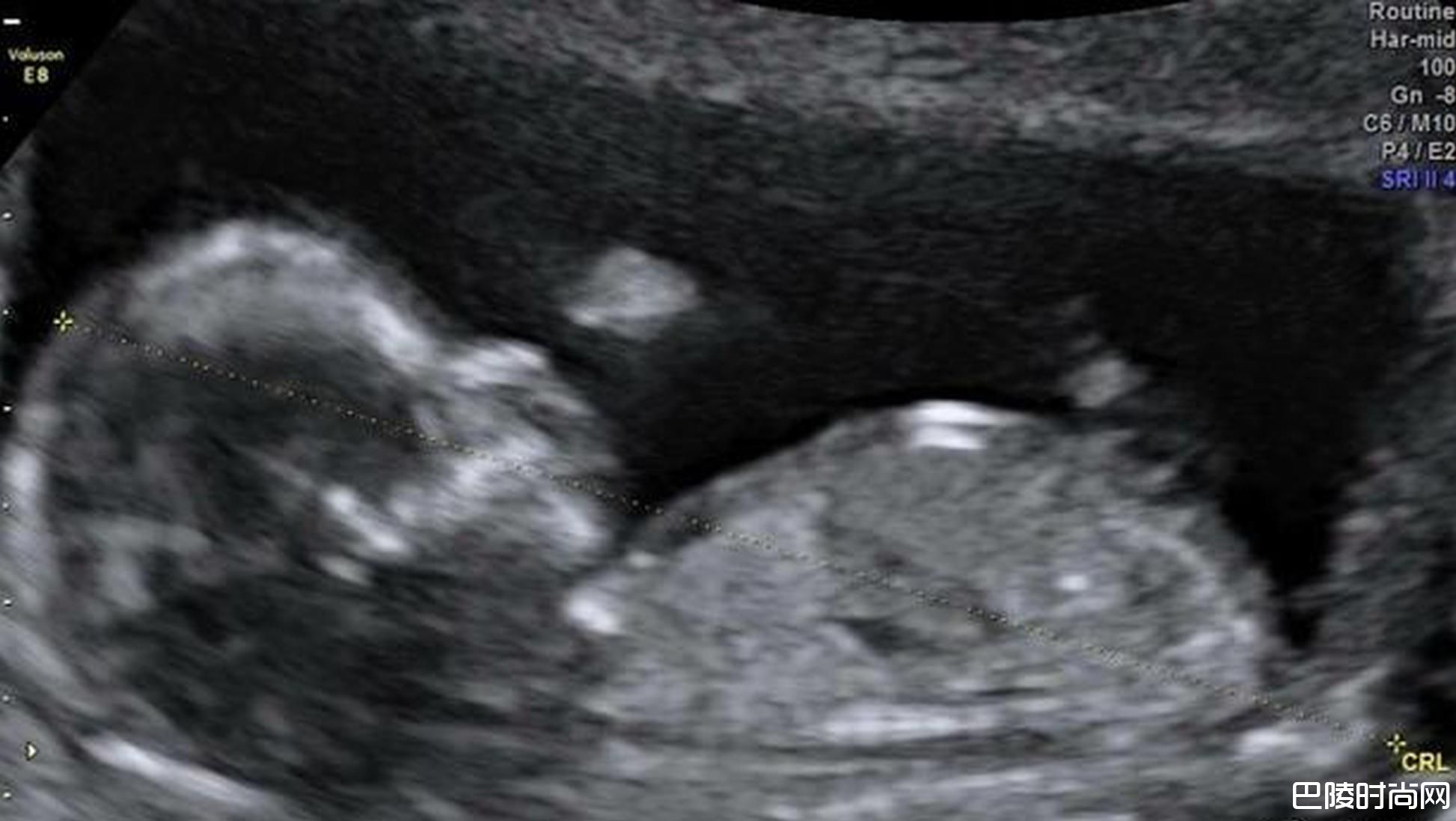 宝宝B超照片