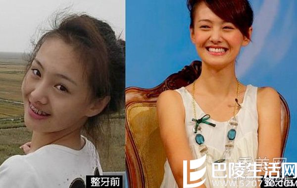 郑爽出道前曾戴过牙套