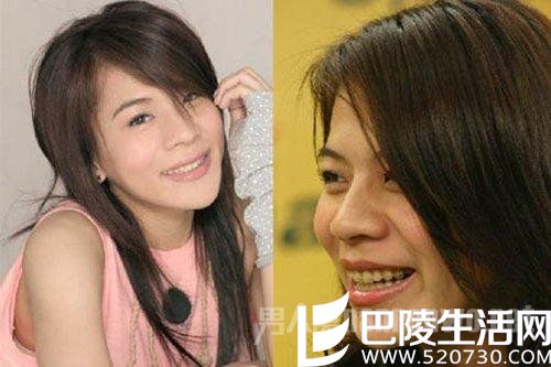 江美琪整牙前后