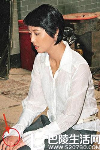 周海媚红斑狼疮症 周海媚红斑狼疮症