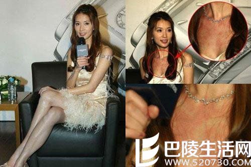 林志玲胸口有一大片红疹 林志玲胸口有一大片红疹