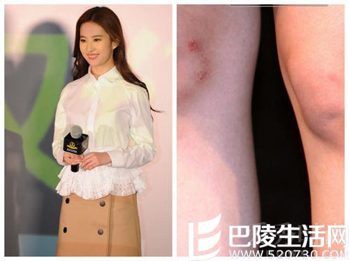 刘亦菲腿部擦伤