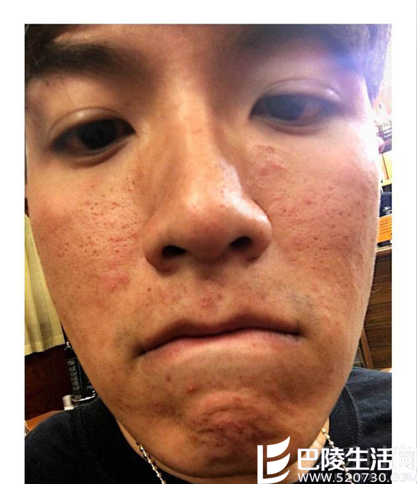 柯震东满脸痘印