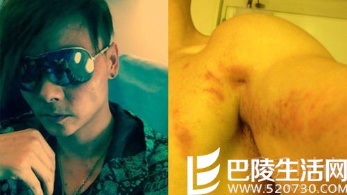 张晋晒胸口淤血照 张晋晒胸口淤血照