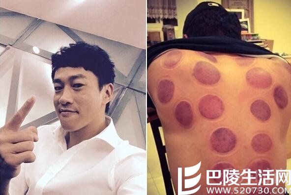 何润东晒拔罐留暗红淤血照 何润东晒拔罐留暗红淤血照