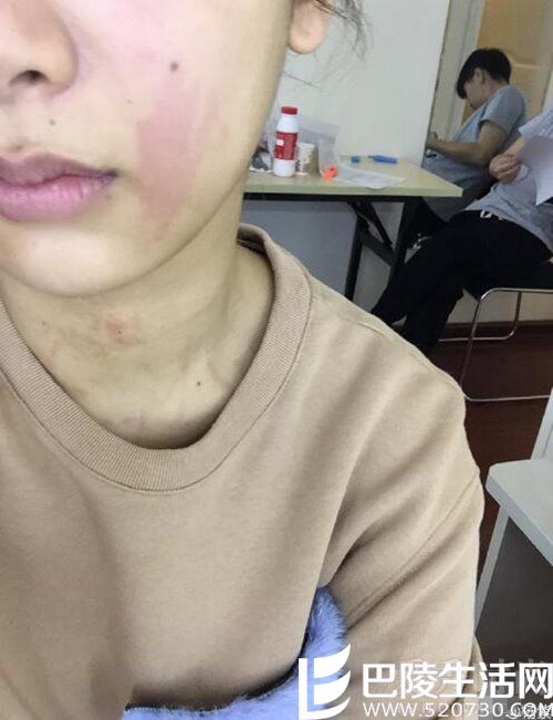 杨紫得荨麻疹 杨紫得荨麻疹