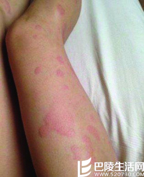 二姐浑身红肿 二姐浑身红肿