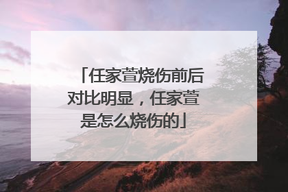 任家萱烧伤前后对比明显，任家萱是怎么烧伤的