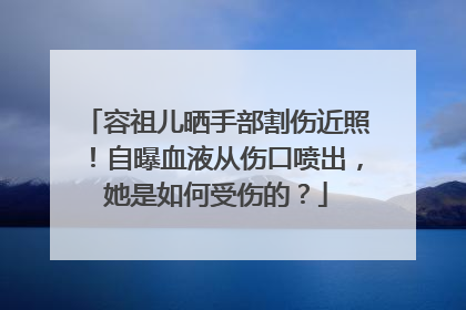 容祖儿晒手部割伤近照！自曝血液从伤口喷出，她是如何受伤的？