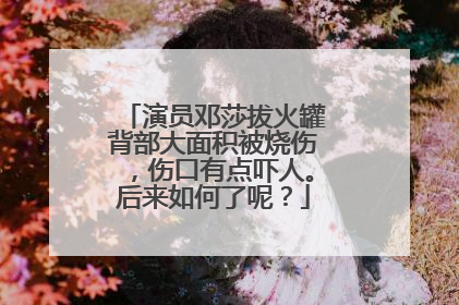 演员邓莎拔火罐背部大面积被烧伤,伤口有点吓人。后来如何了呢?