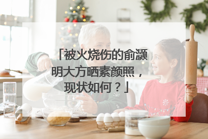 被火烧伤的俞灏明大方晒素颜照,现状如何?
