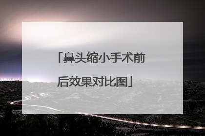 鼻头缩小手术前后效果对比图