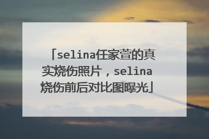 selina任家萱的真实烧伤照片，selina烧伤前后对比图曝光